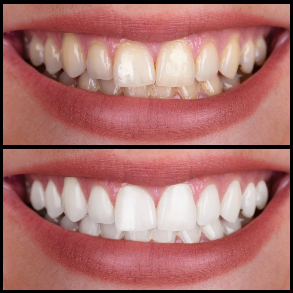 رحلة التبييض: سر الابتسامة المثالية