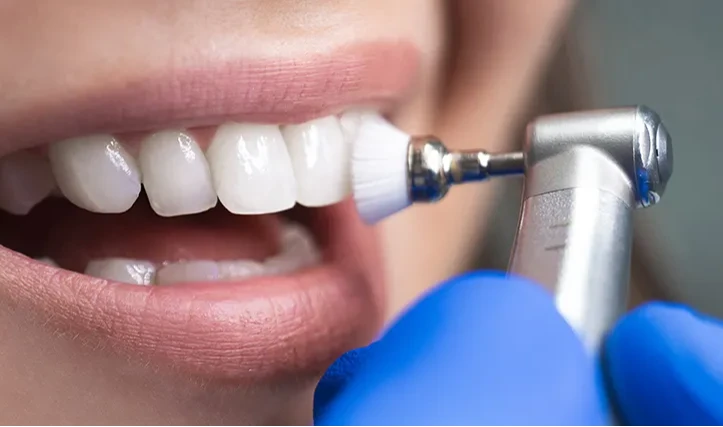 تنظيف الاسنان